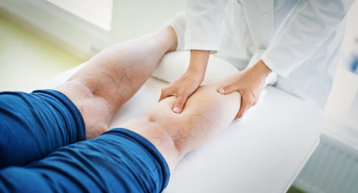 professional vein doctor inspecting patients leg which has spider and varicose veins