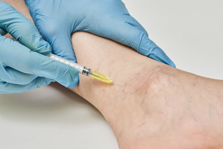 doctor performing sclerotherapy on persons varicose veins on leg