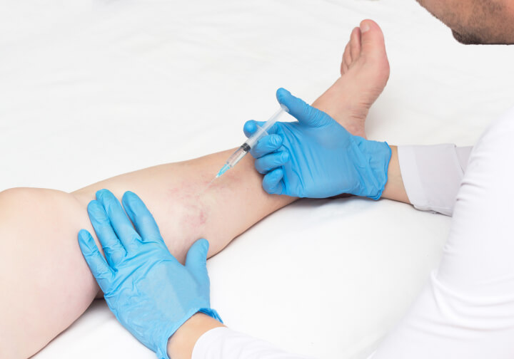 professional vein doctor performing sclerotherapy on a patient's varicose veins leg