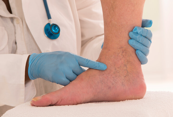 a professional vein doctor examines varicose and spider veins on a person's foot