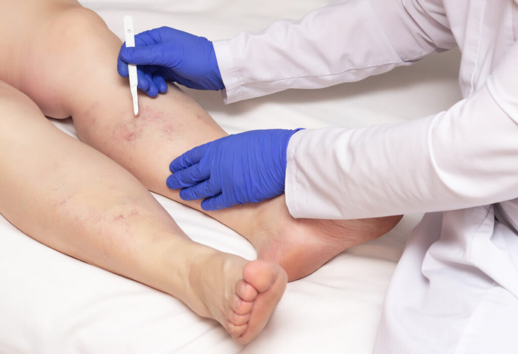 professional vein doctor examines the varicose veins on a woman leg