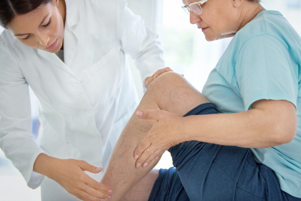 elder woman in pain with spider and varicose veins consulting with professional vein doctor 