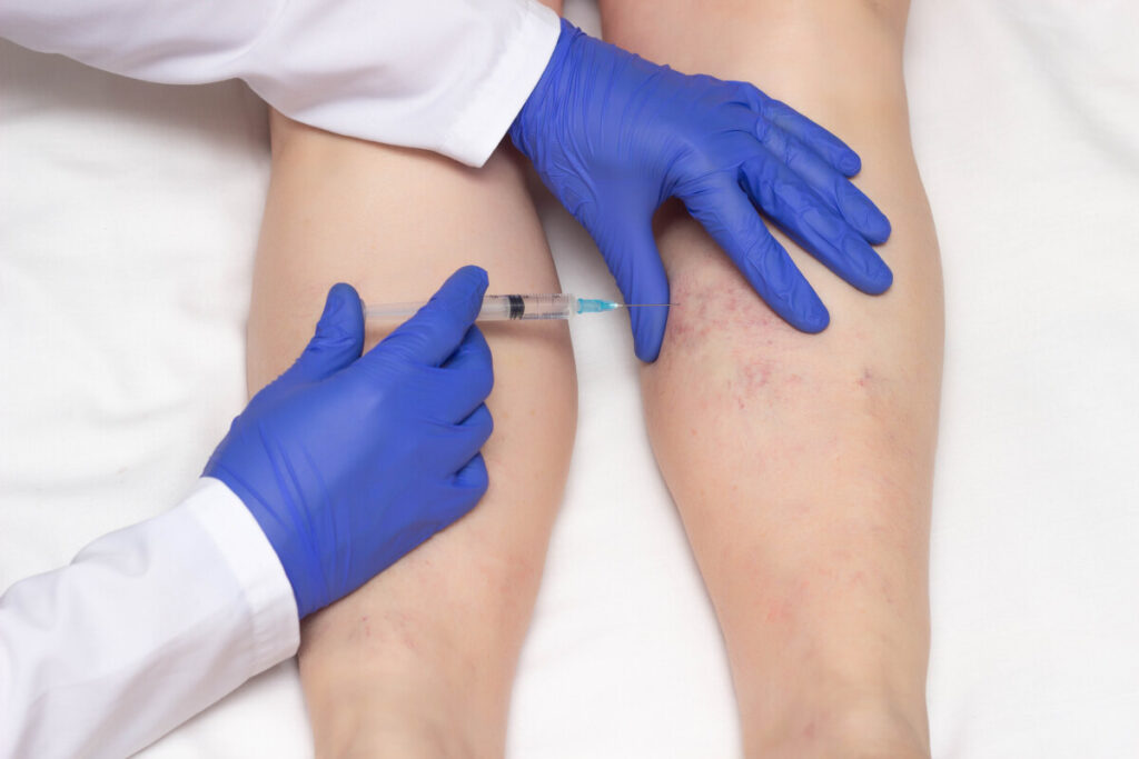 professional vein doctor performing sclerotherapy on a woman's leg which has varicose veins 
