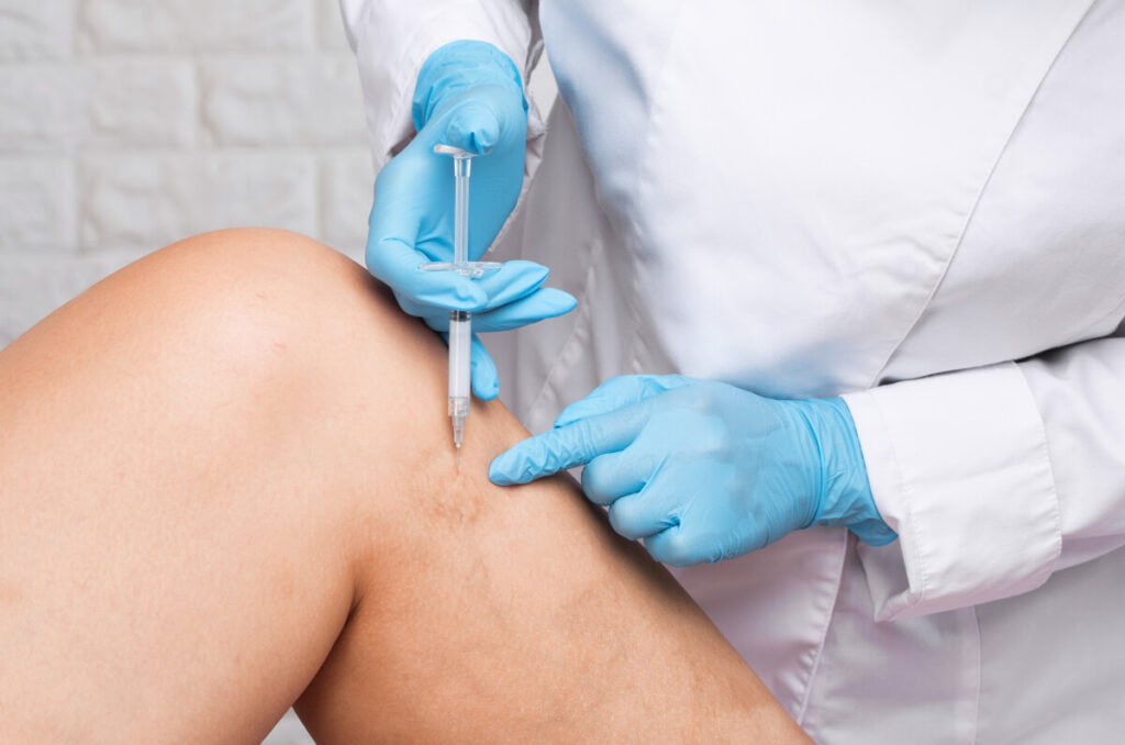 varicose veins and spider veins treated with slerotherapy by a professional vein doctor