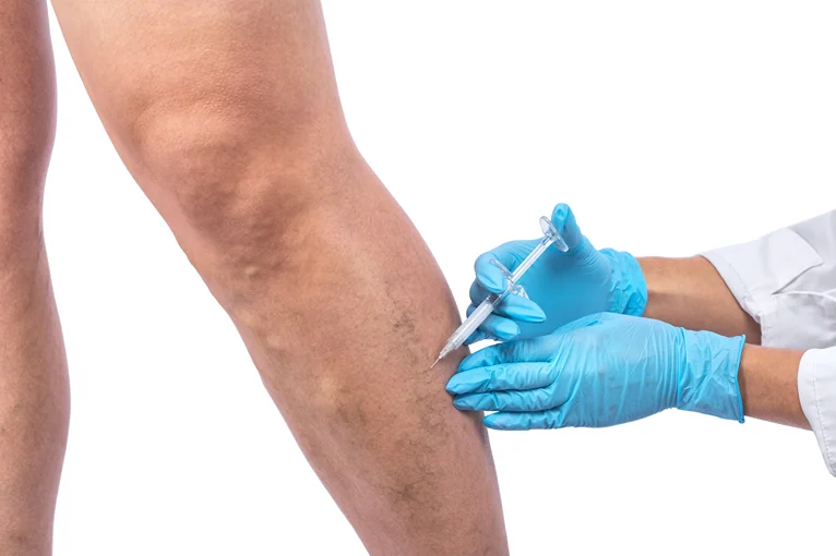 Gloved hands injecting a legs with chronic venous insufficiency.