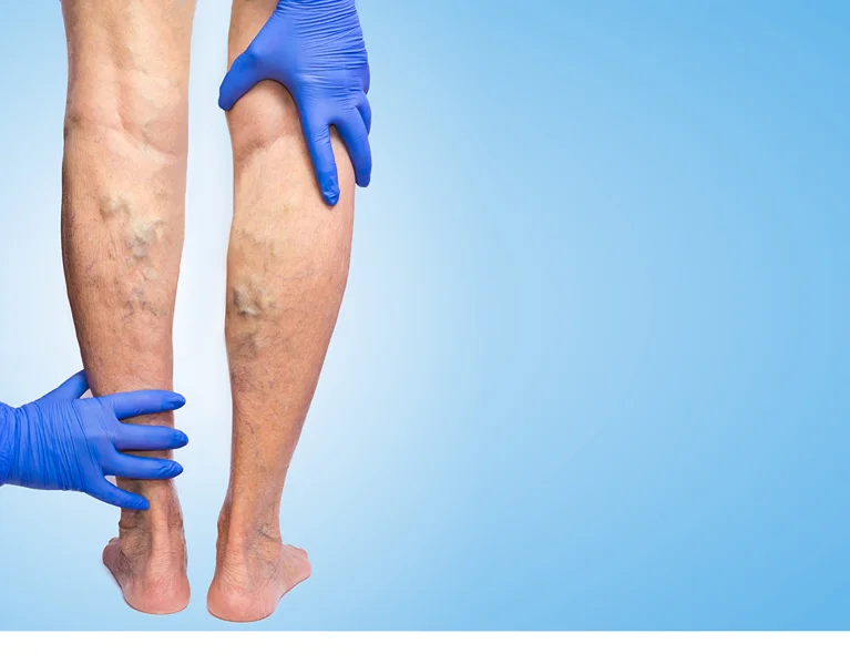 Back of legs having chronic venous insufficiency held by hands with blue gloves.
