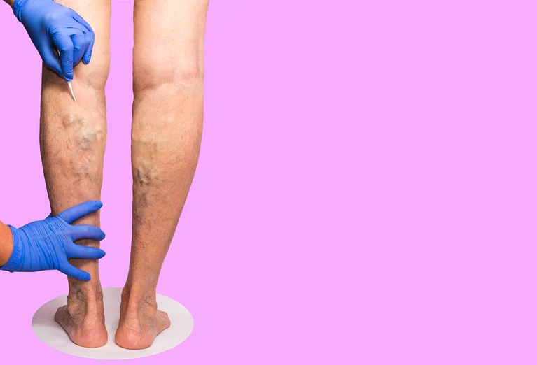 Back of the legs with chronic venous insufficiency with one leg held by hands in blue gloves.
