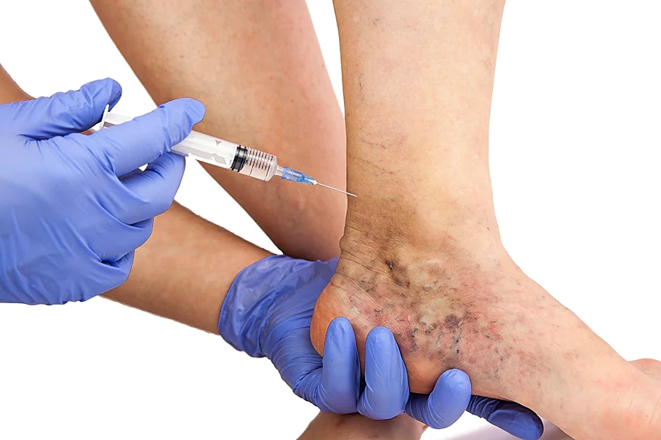 Here’s Why You Should Consider Ablation Treatment to Treat Chronic Venous Insufficiency