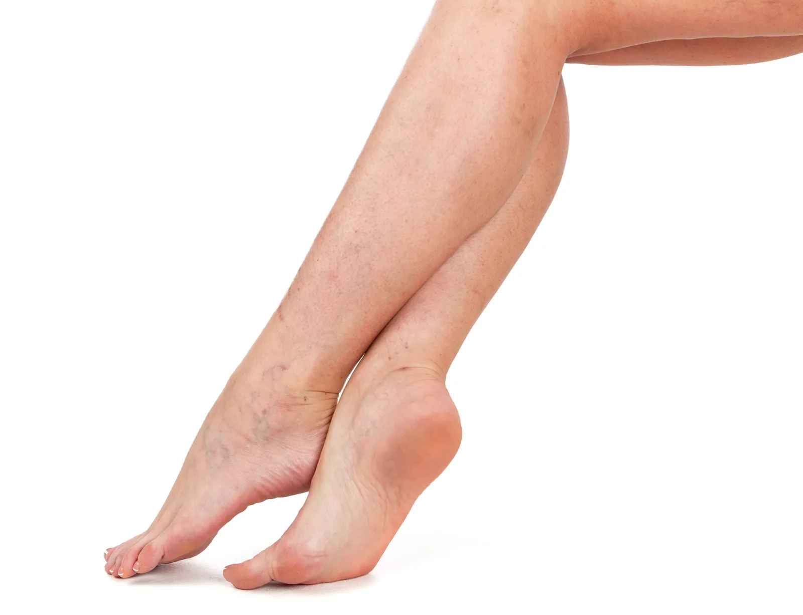 Acute Venous Disease vs Chronic Venous Insufficiency: