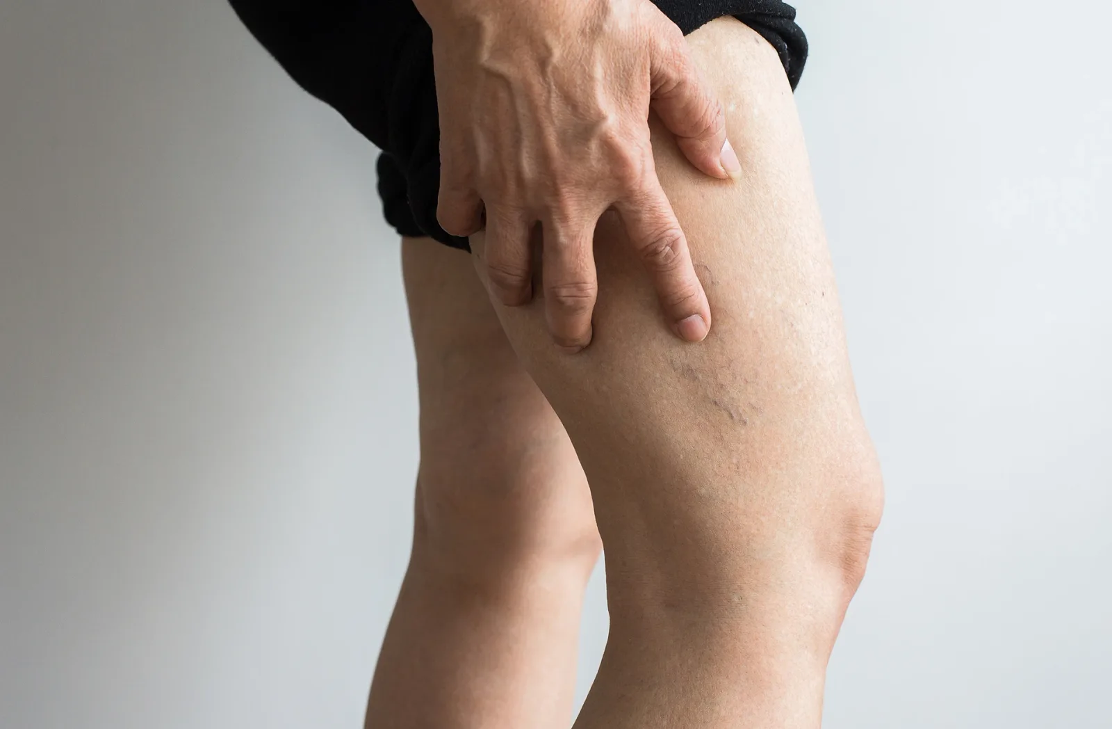Collapsing Spider Veins: Causes, Symptoms, and Modern