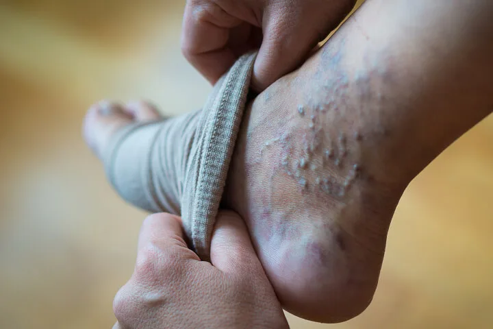 Can Chronic Venous Insufficiency Be Corrected By Using