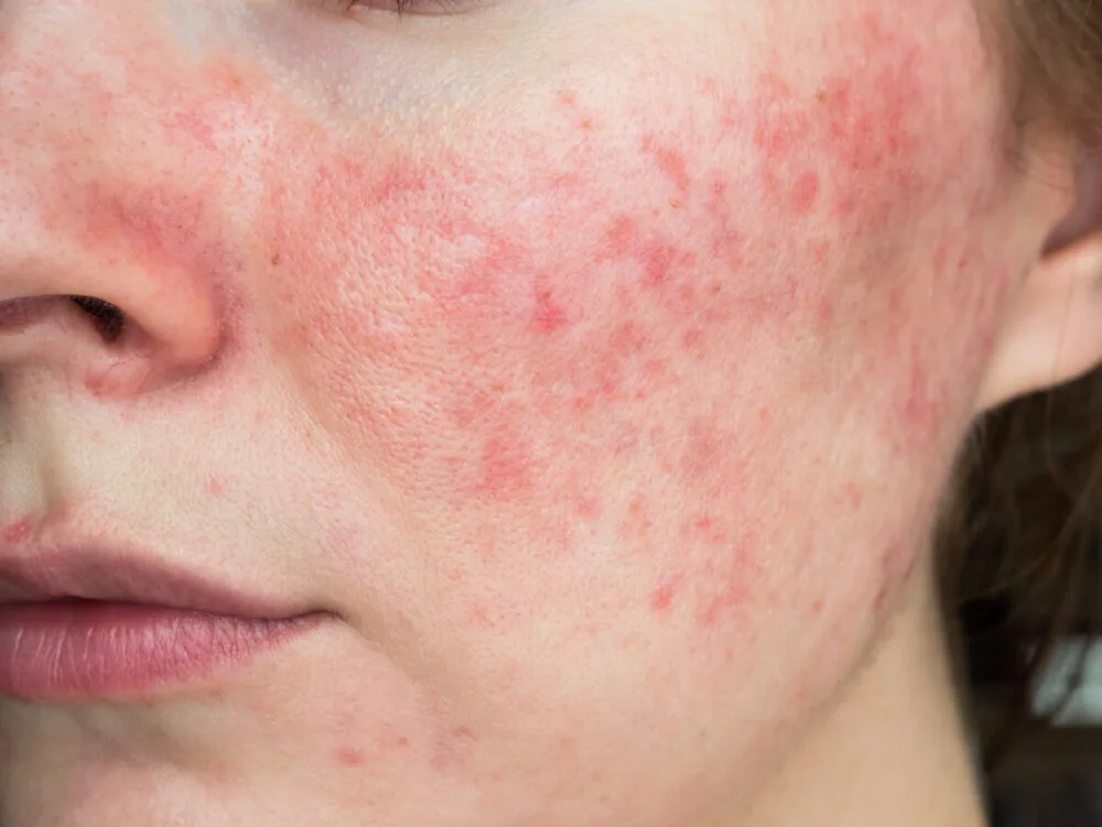 When To Take Your Child to the Dermatologist for Facial