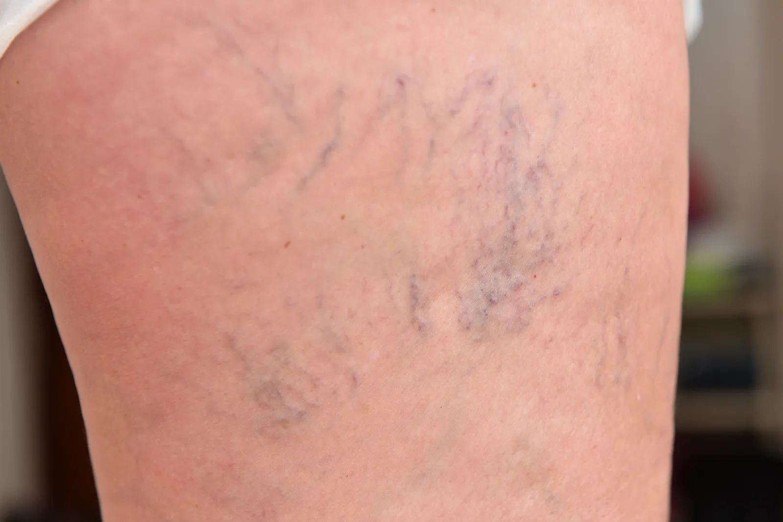 Stop the Cycle: Breaking Free of Hereditary Telangiectasia