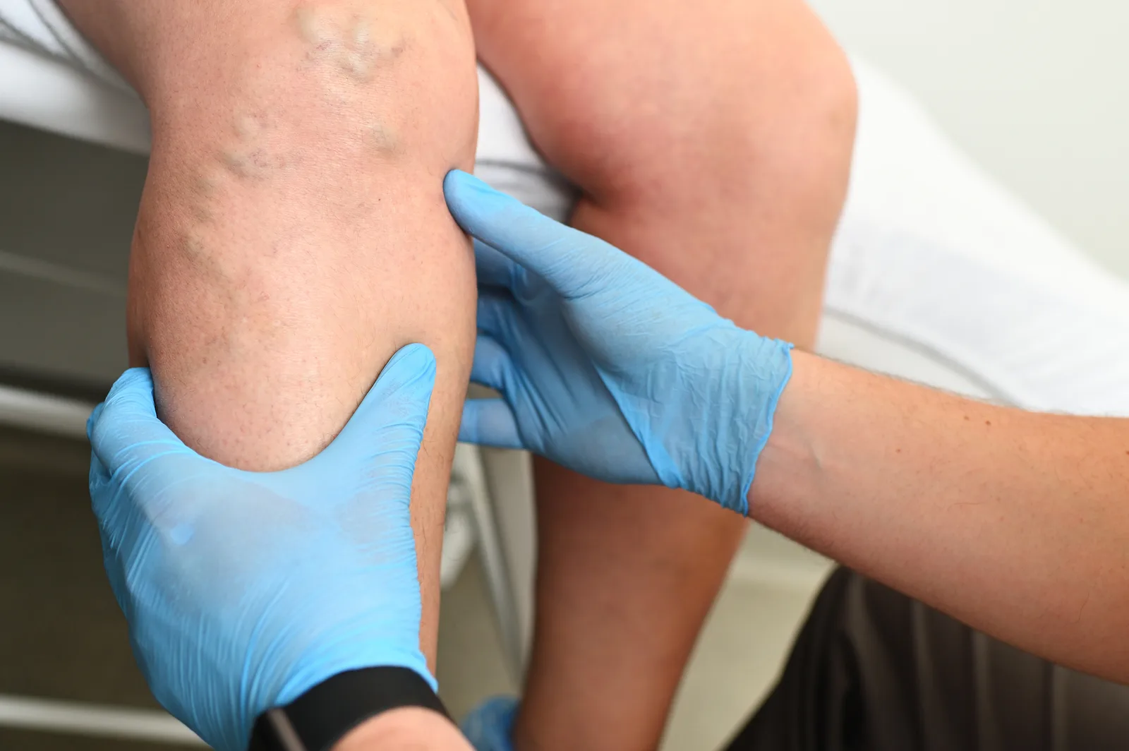 Is Phlebitis a Blood Clot? Superficial Phlebitis vs. DVT