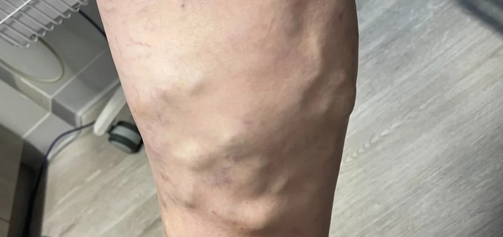Is Phlebitis a Blood Clot? Superficial Phlebitis vs. DVT