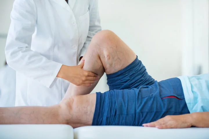 doctor inspecting a leg of patient which is full of varicose and spider veins