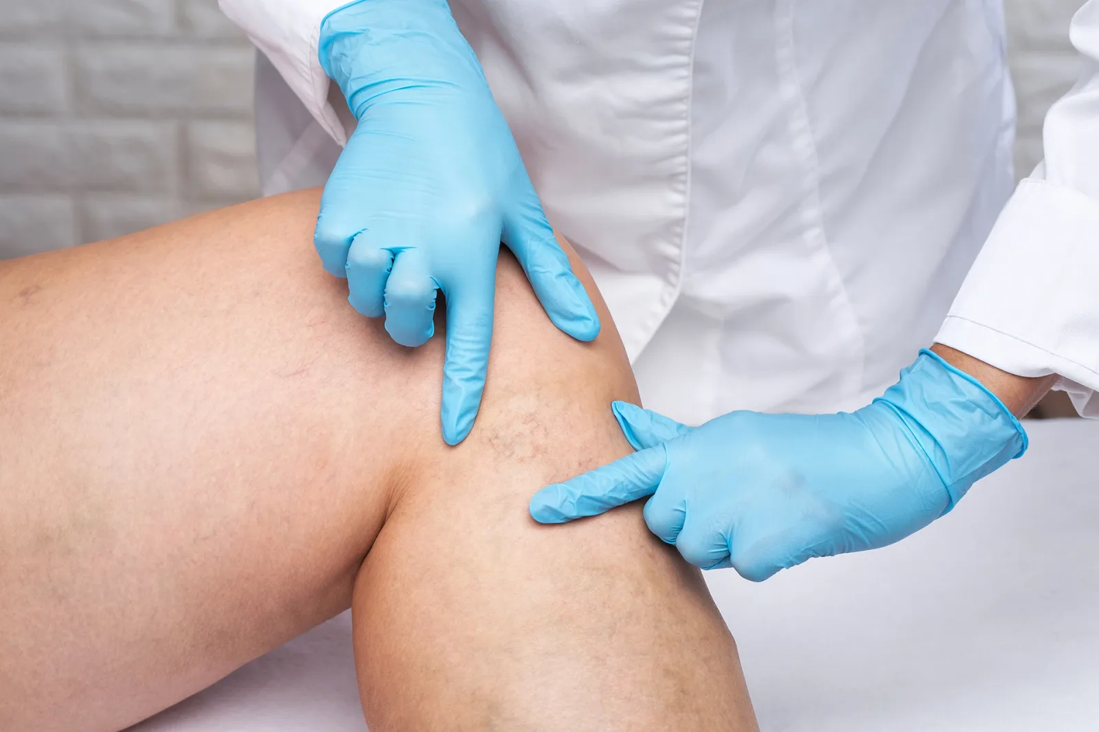 Men With Spider Veins: Debunking the Myths and Embracing