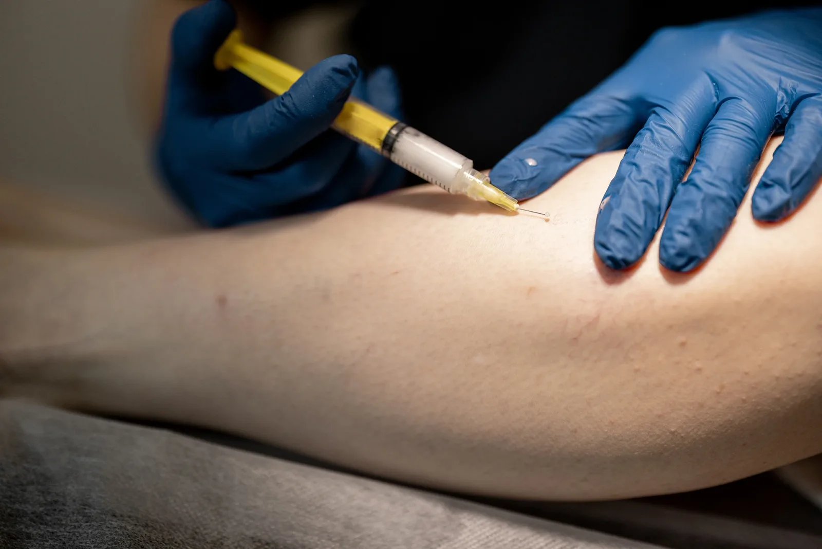 Micro Sclerotherapy for Spider Veins Cost: In-Depth Guide