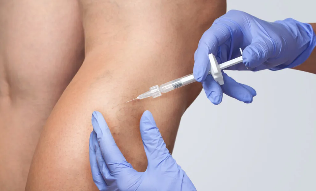 sclerotherapy performed by professional vein doctor on a person leg with varicose veins