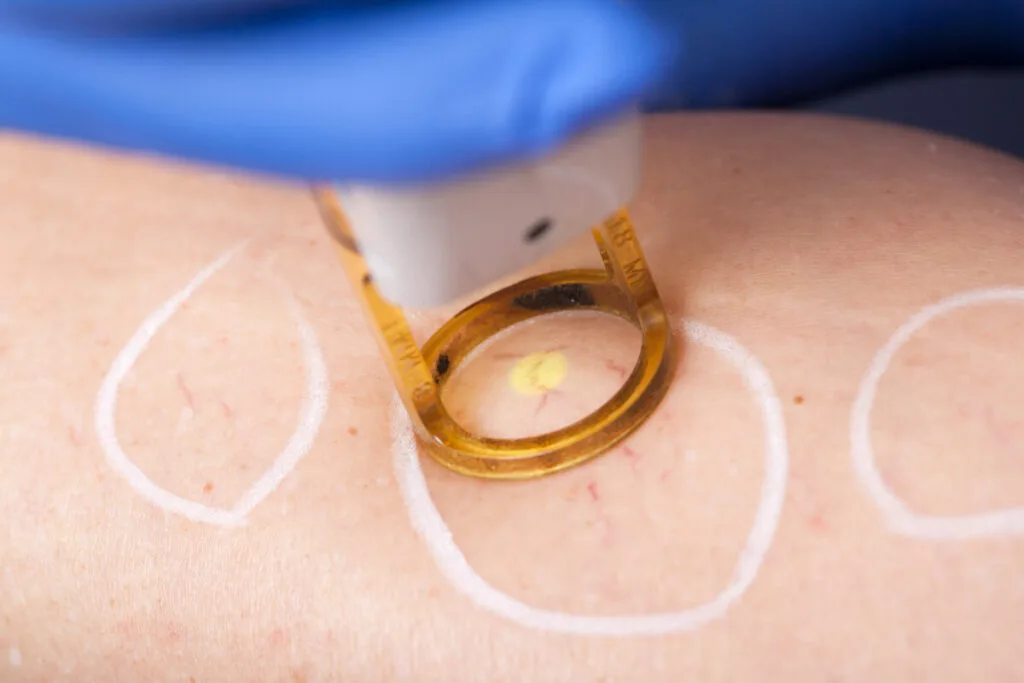 laser vein treatment performed by professional vein doctor on varicose and spider veins