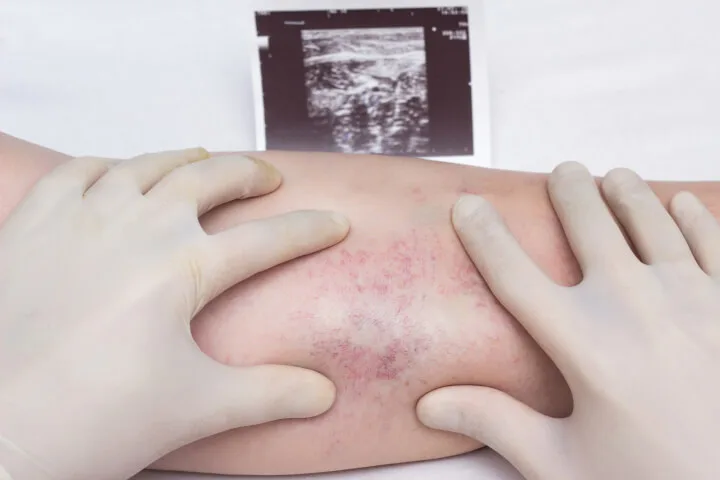Reticular Veins vs. Varicose Veins: What Are The Differences