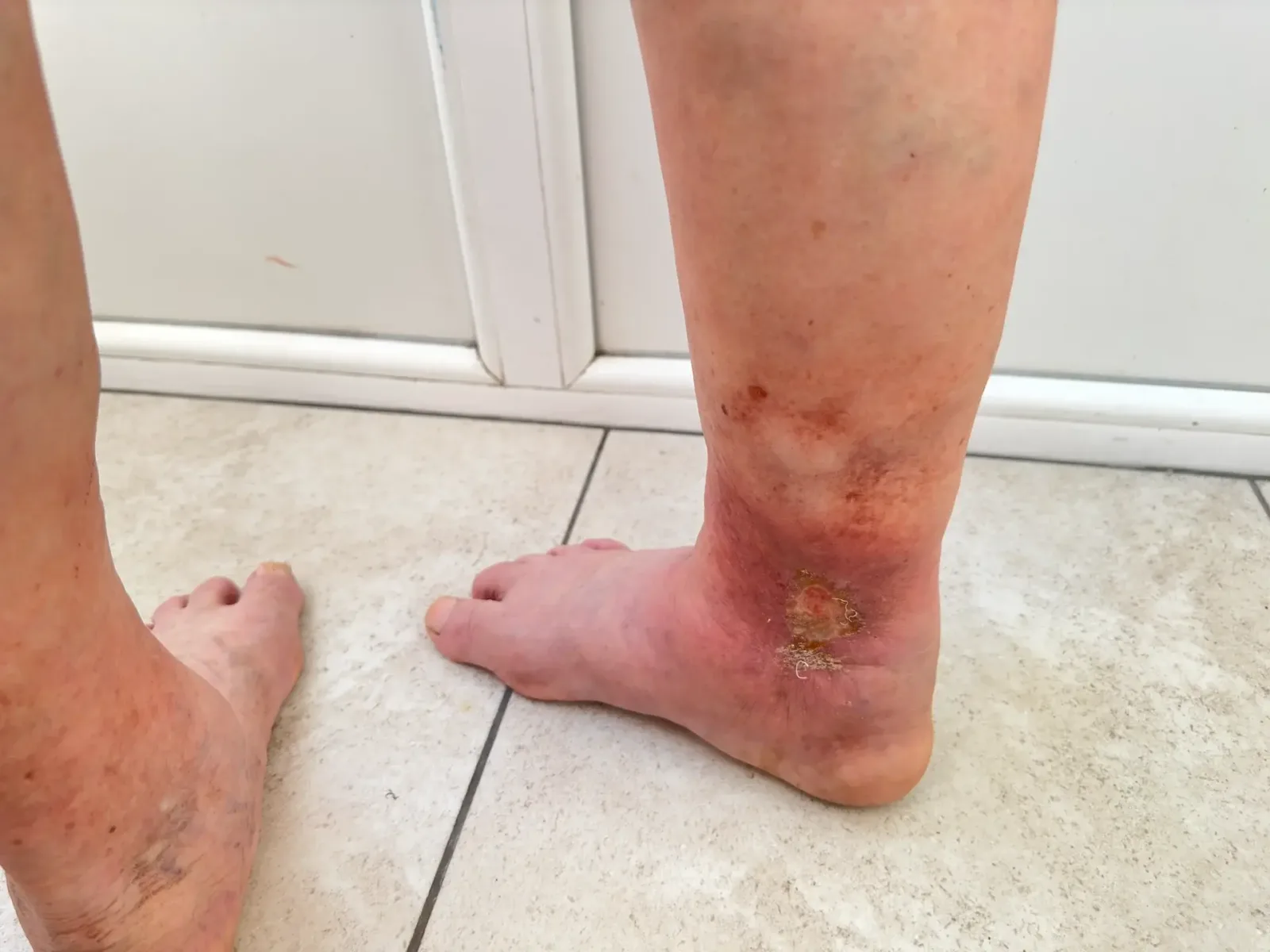 What You Need to Know About Venous Ulcers and Poor