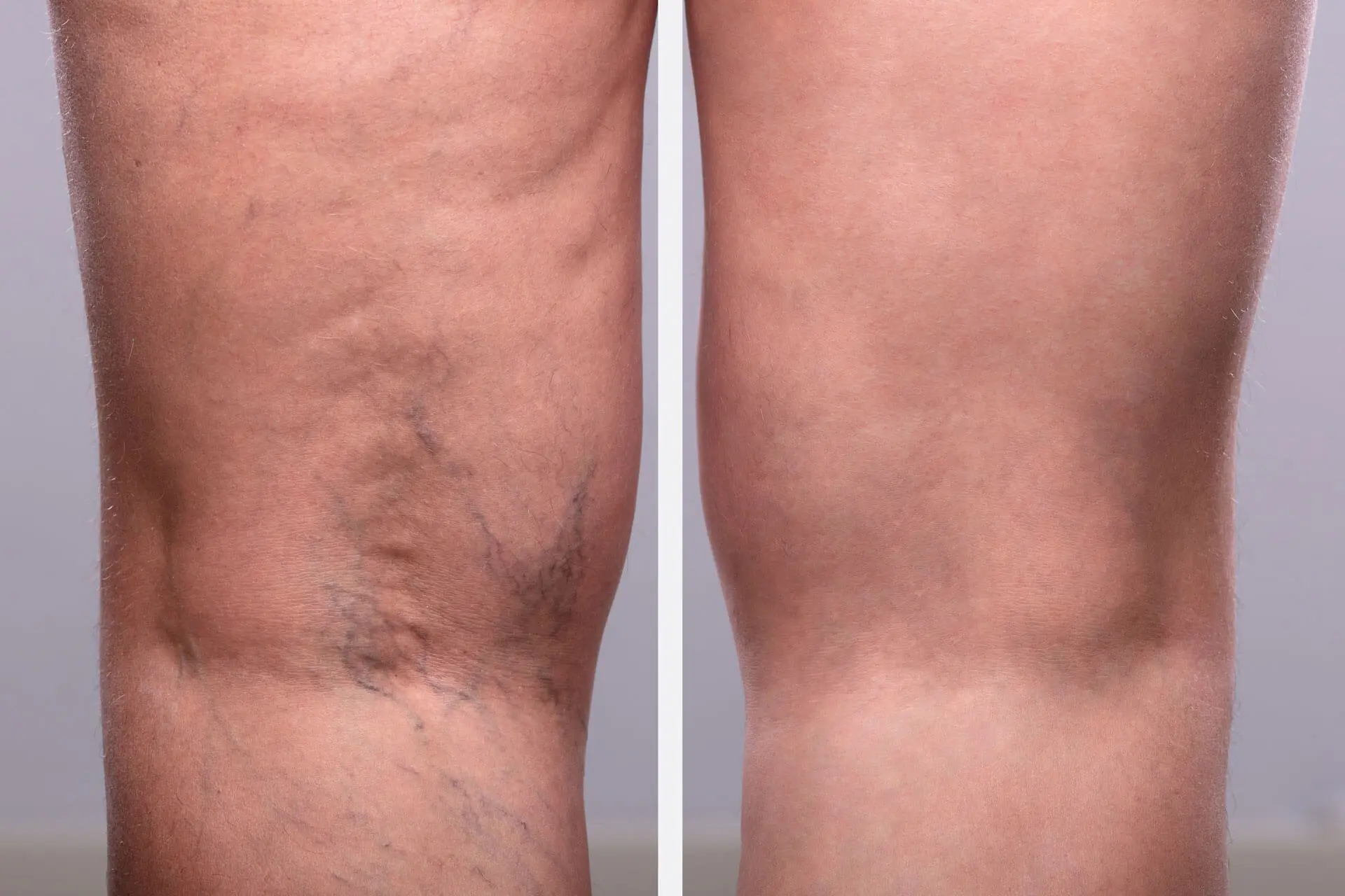 Before and after vein treatment results