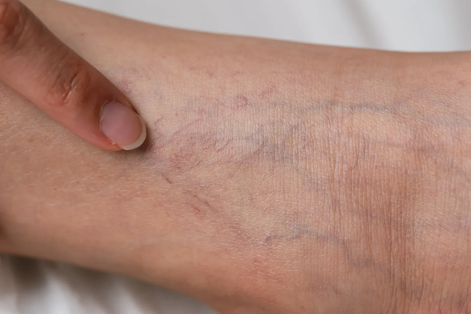 Spider vein evaluation at Vein Center Doctor