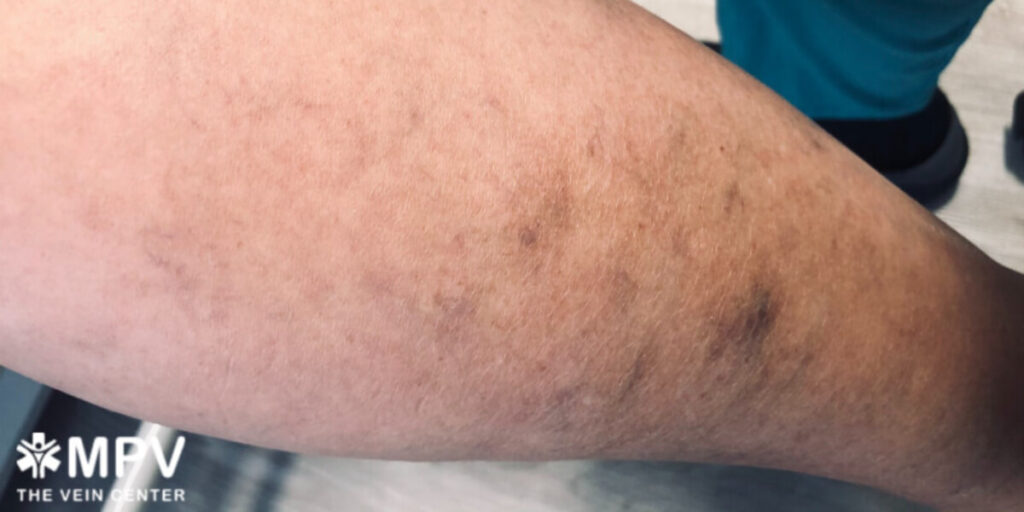 Spider veins on the leg