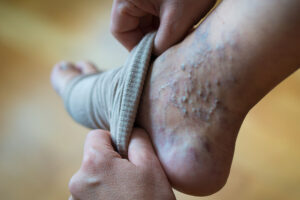 compression stocking on varicose vein leg|