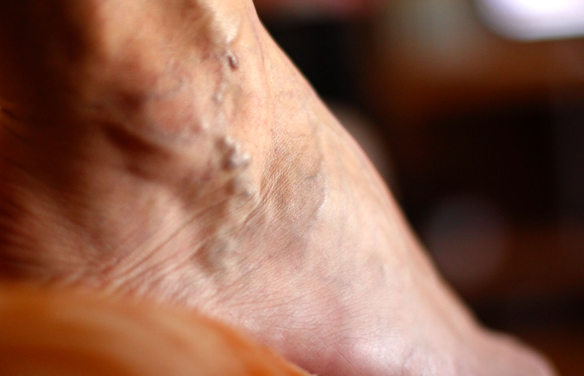 What Is The Hard Lump On The Varicose Vein Vein Center Doctor