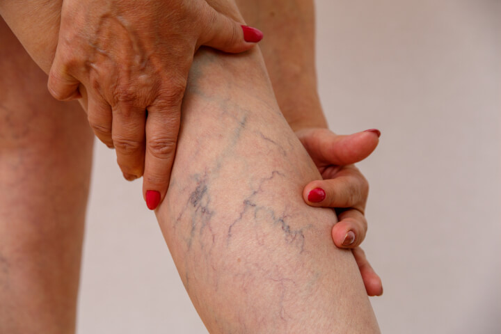 varicose veins under persons knee