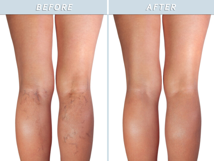 varicose veins treated by professional