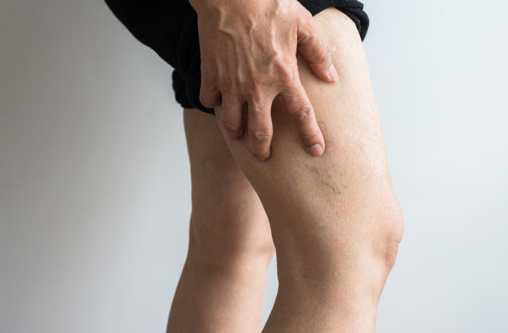 woman concerned and in pain over varicose and spider veins on her leg