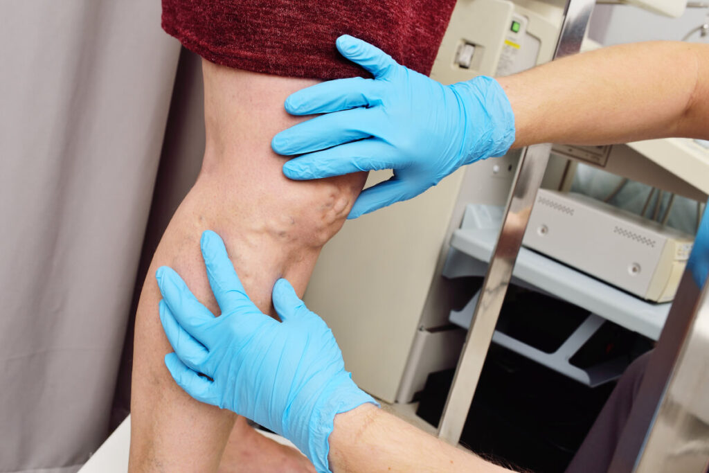 dilated leg veins caused by chronic venous insufficiency observed by a professional vein doctor