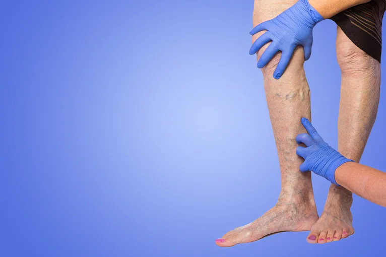 Leg with gloved hands checking chronic venous insufficiency