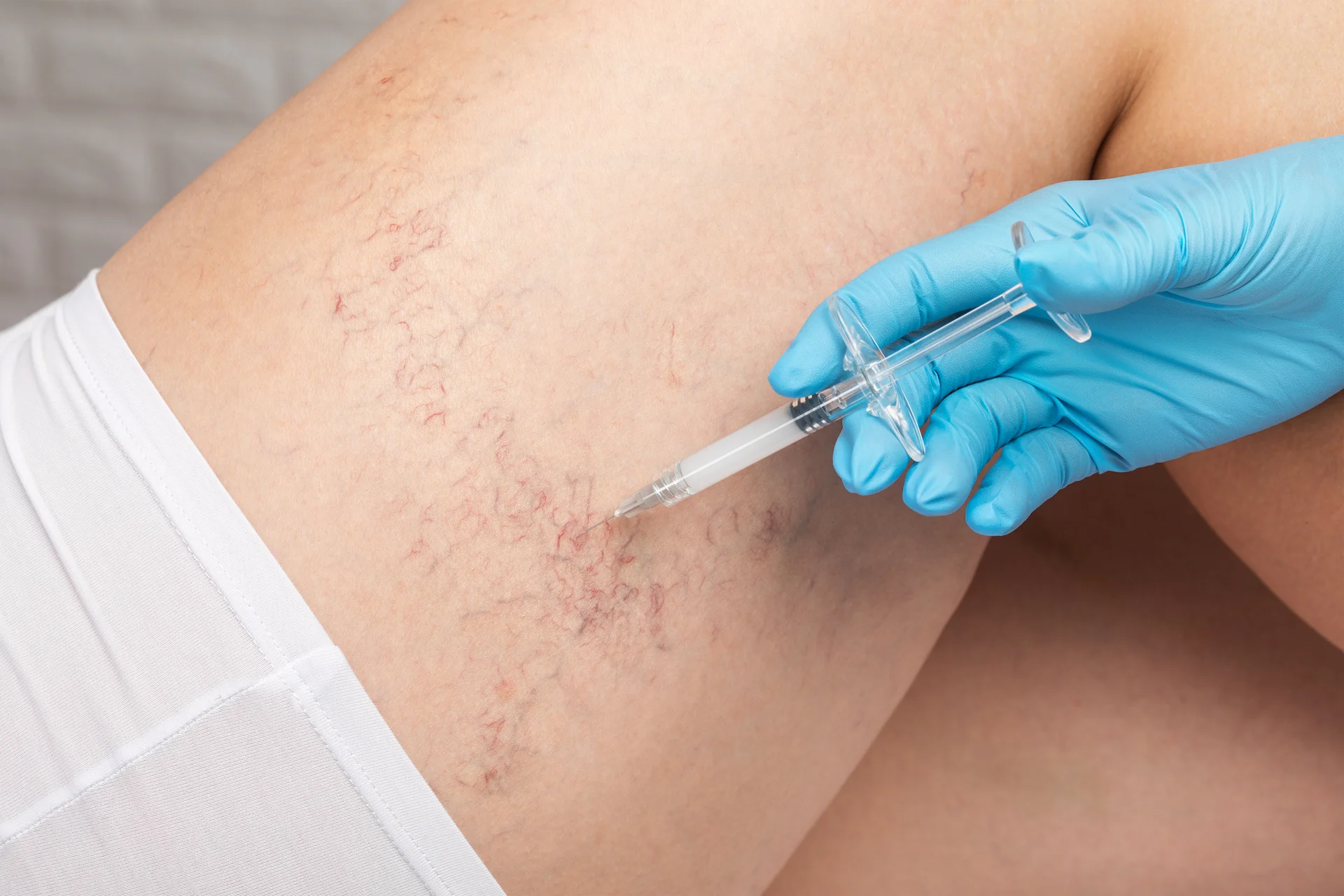 Injection to leg for vein problem treatment