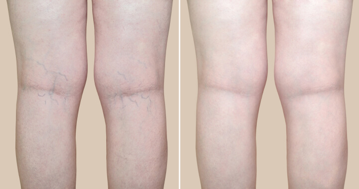 varicose veins on female legs before and after treatment