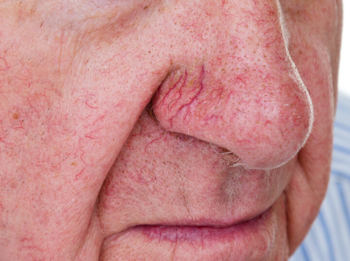 man with spider veins on his nose