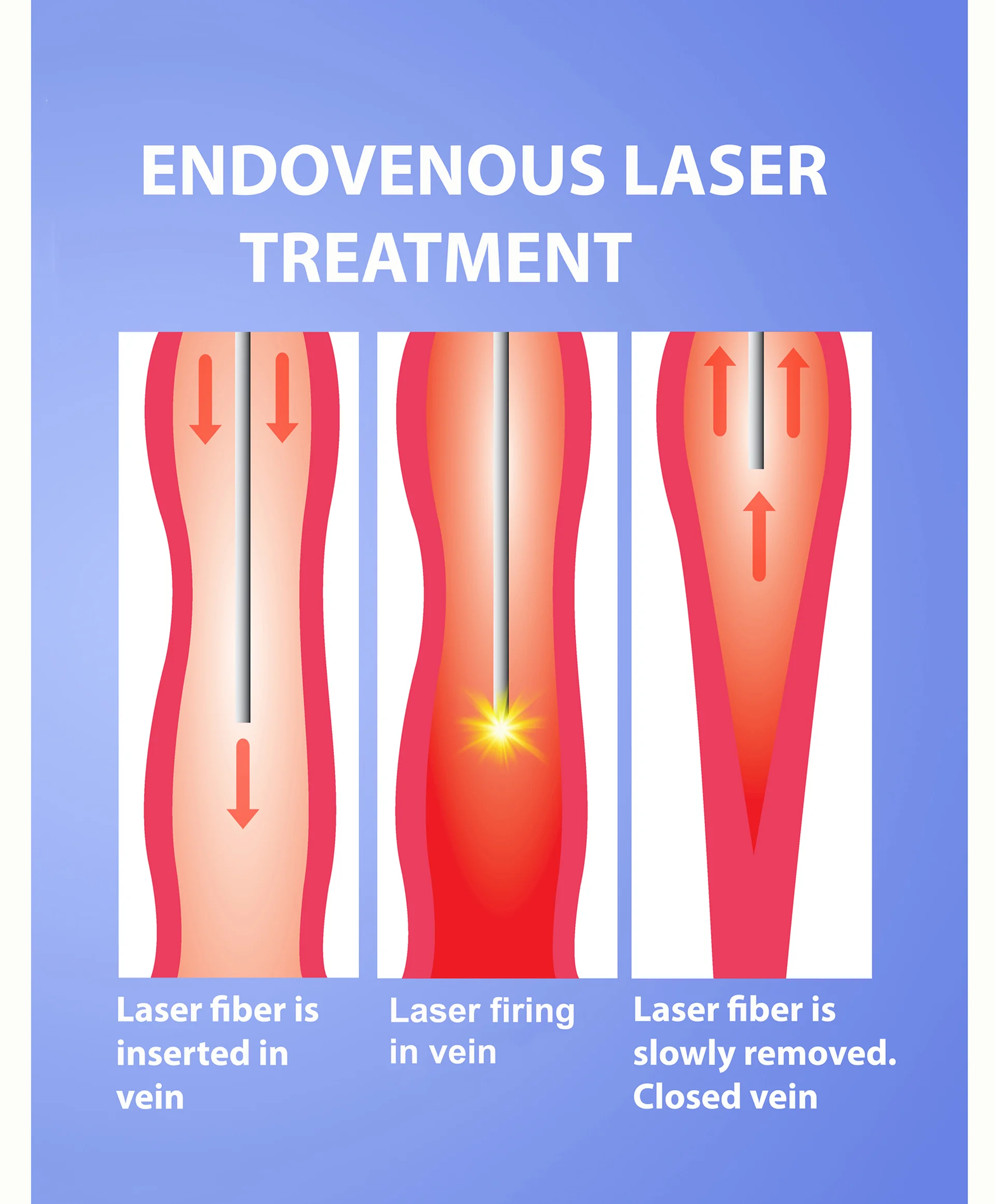 Endovenous laser treatment infographic.