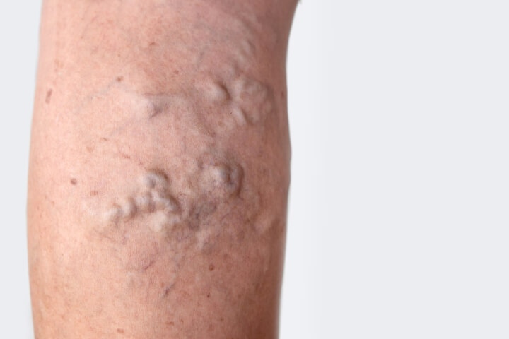 varicose veins on female inner thigh