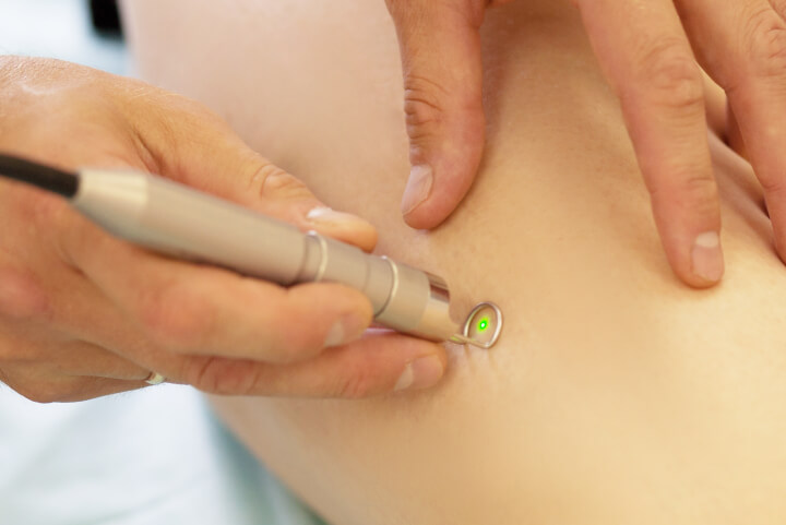 spider veins laser treatment by professional vein doctor