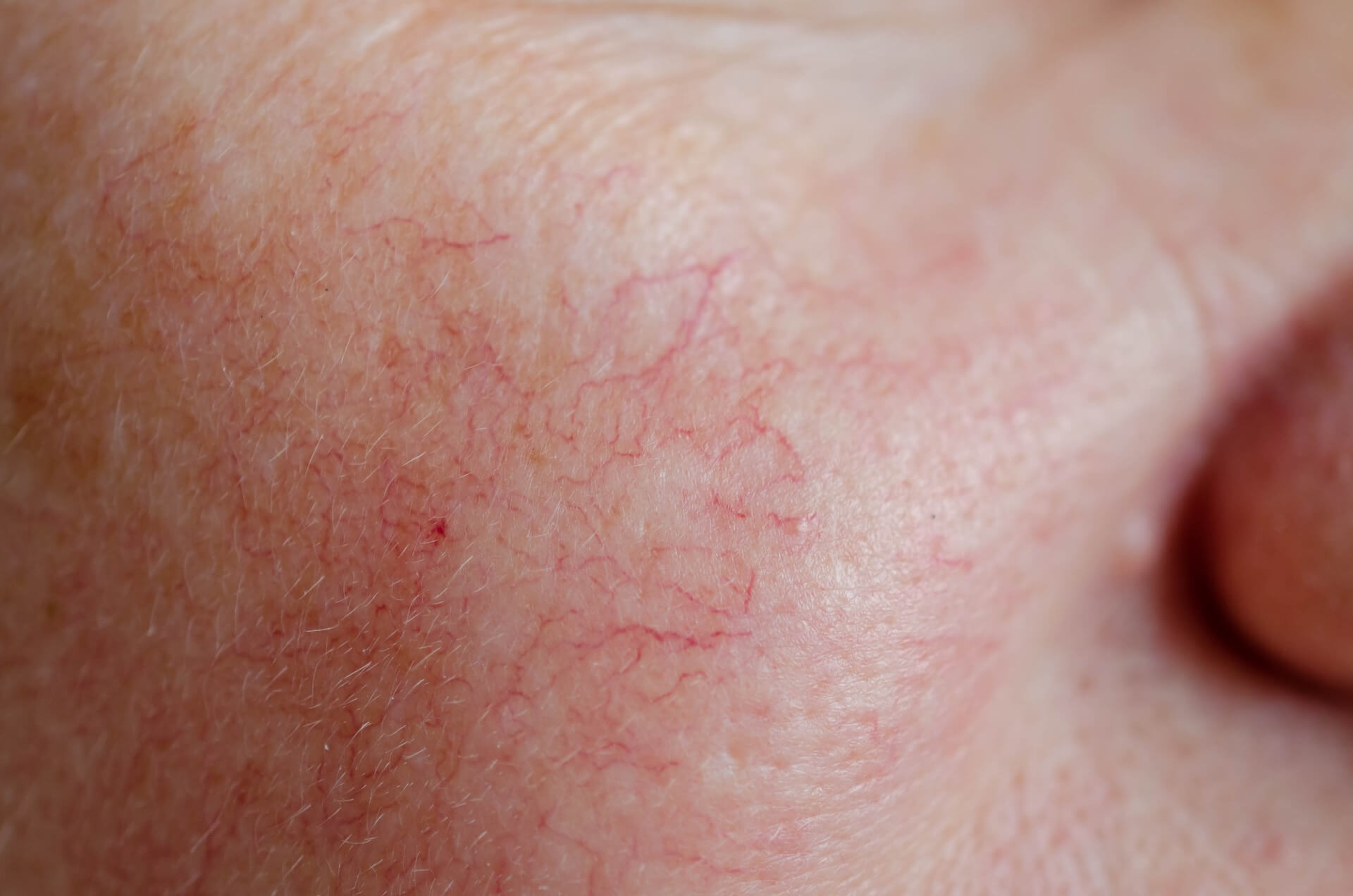 Spider veins on face