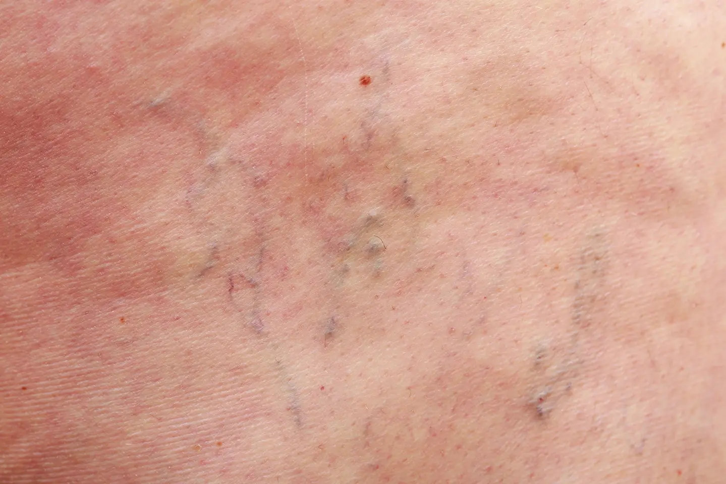 blue spider veins on chest