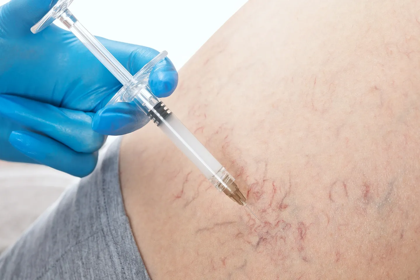 side effects of spider vein injections