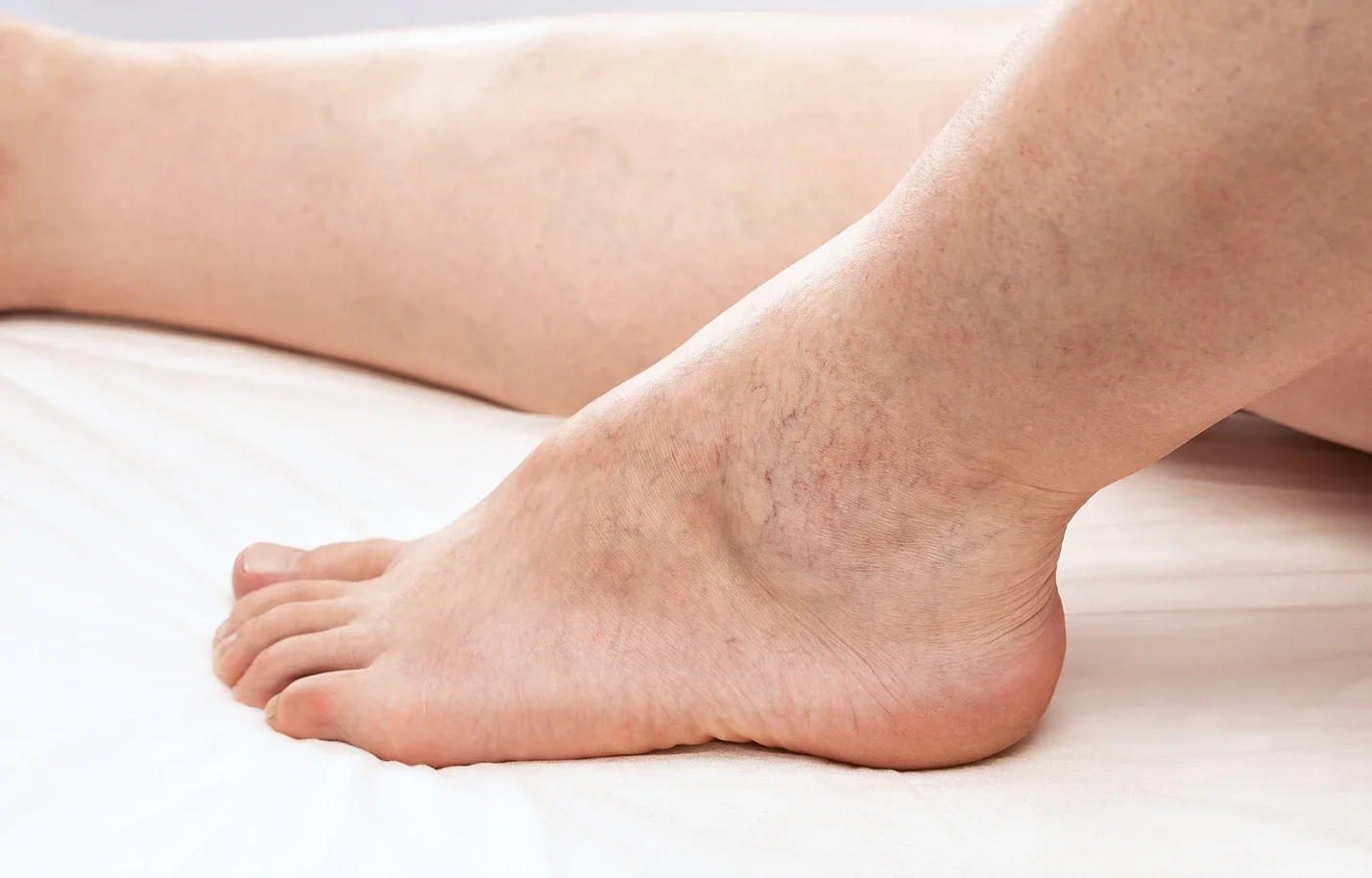 spider veins and stroke